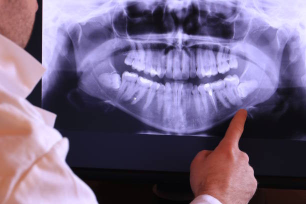 Best Emergency Wisdom Teeth Removal in Trafalgar, IN